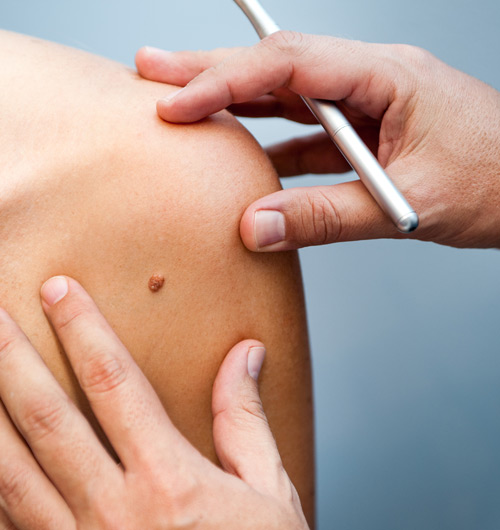 closeup of a doctor examining a mole